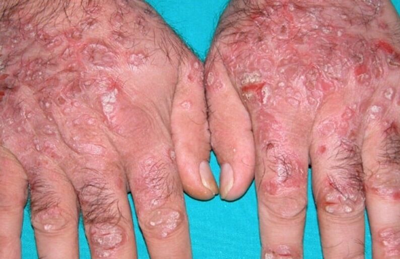 psoriasis en forme de larme sur les mains