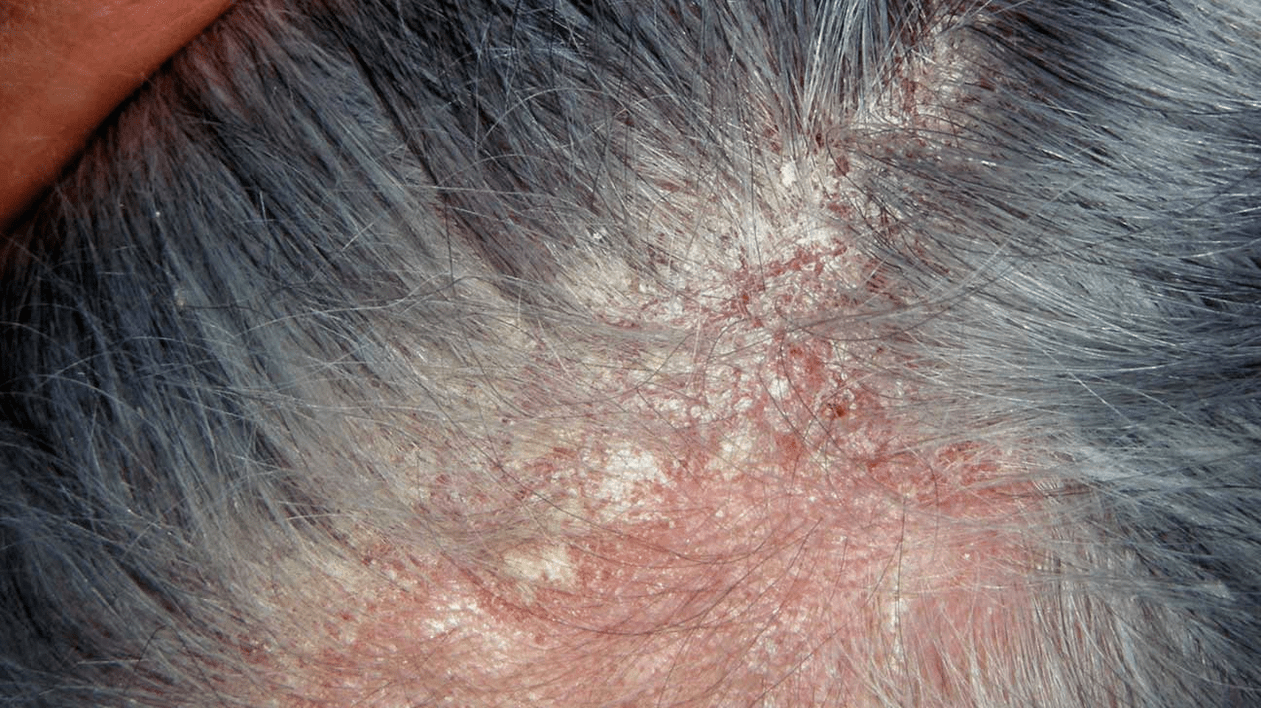 psoriasis séborrhéique sur la tête
