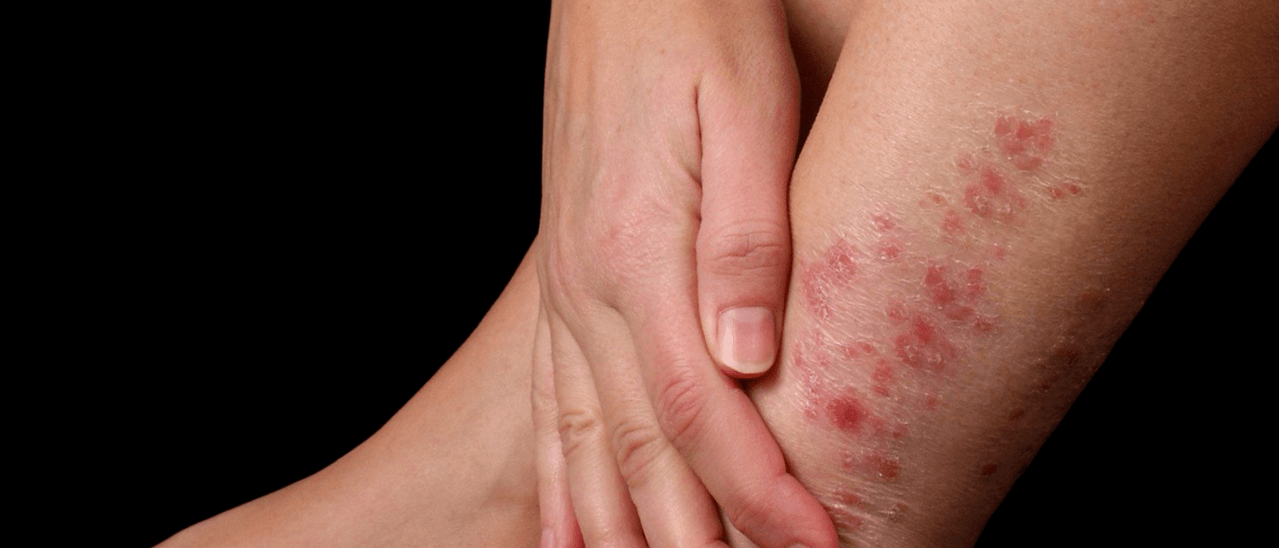 Plaques de psoriasis sur la peau de la jambe