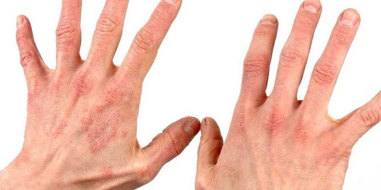 psoriasis sur les mains comment traiter les remèdes populaires