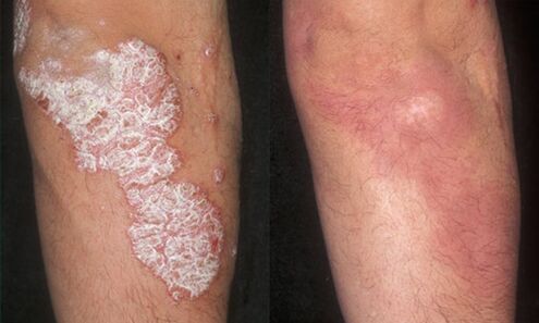 photos avant et après le traitement du psoriasis