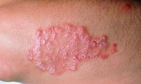 psoriasis sur la peau photo 2