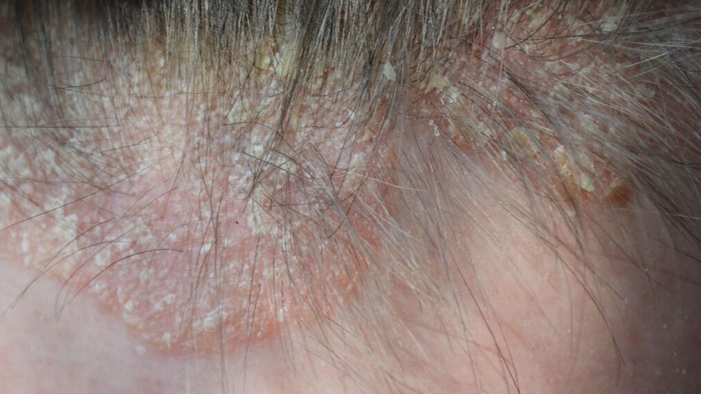psoriasis sur la tête photo 4