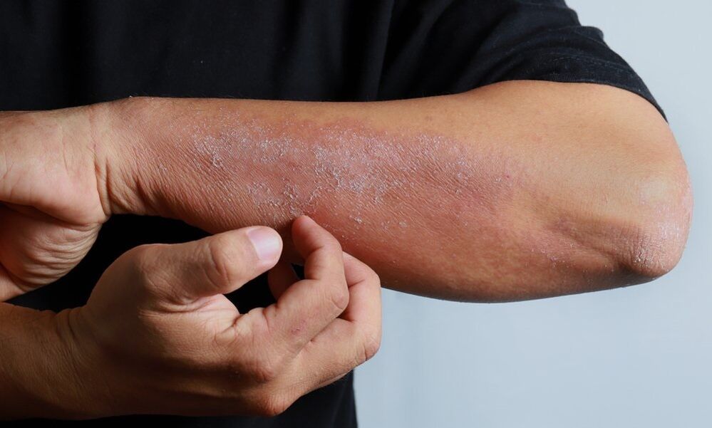 symptômes de psoriasis sur le bras
