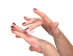 le psoriasis sur les mains