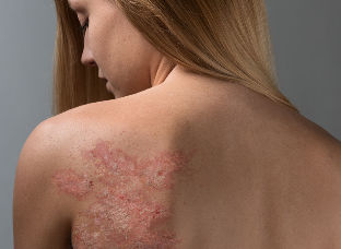 le psoriasis2